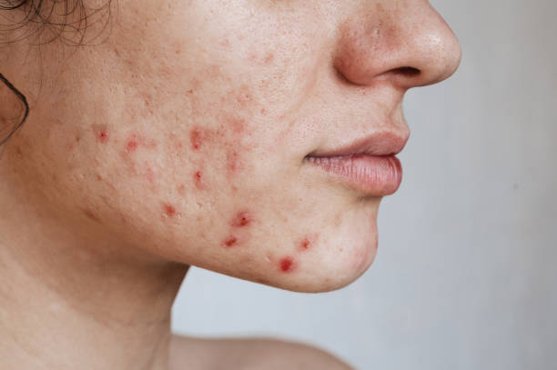 Does Acne Treatment reduce acne marks permanently