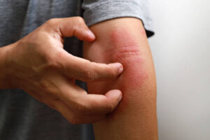 Does Eczema Treatment Work for All Ages