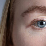 Does Eyelid Surgery Leave Visible Scars