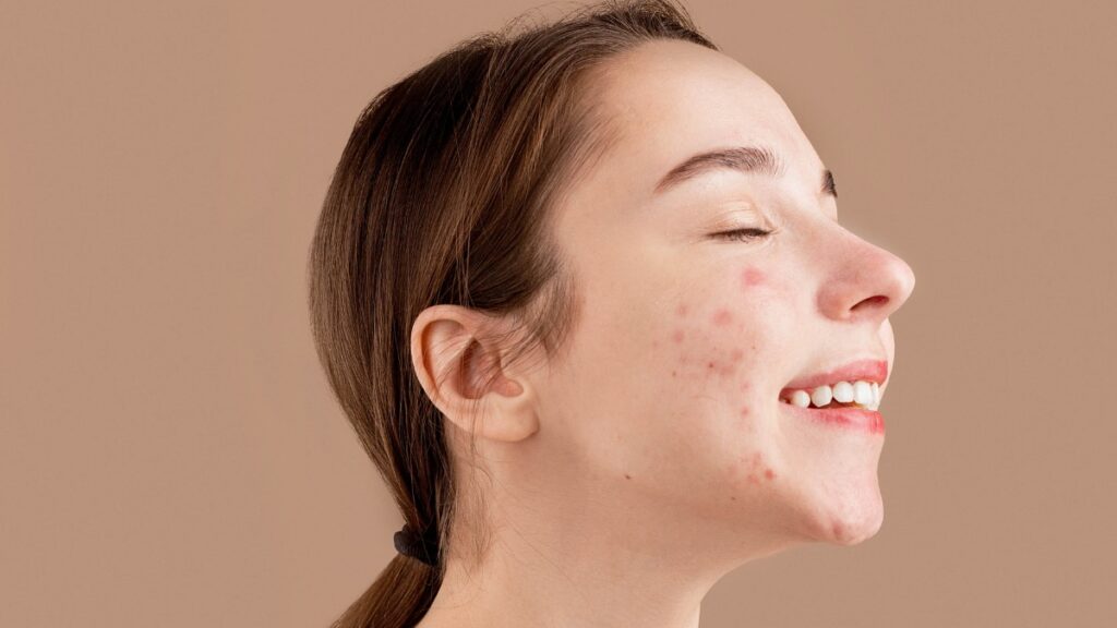 Does Laser Acne Scar Treatment Brighten Skin