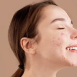 Does Laser Acne Scar Treatment Brighten Skin