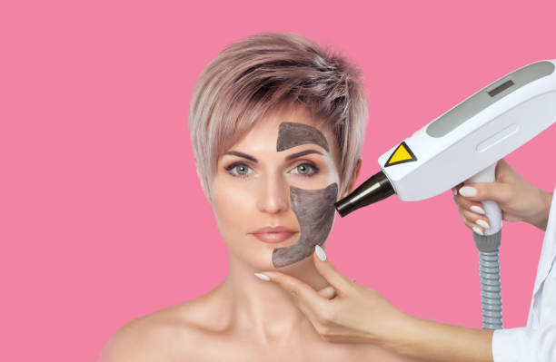 Does Laser Carbon Peel Help Remove Excess Oil and Dullness