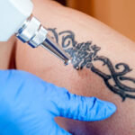 Does Laser Tattoo Removal Work on Dark Skin