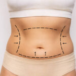 Does Liposuction Help with Body Contouring Goals
