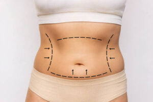 Does Liposuction Help with Body Contouring Goals
