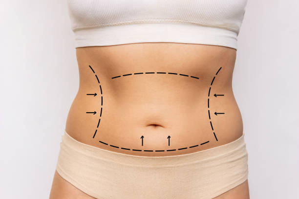 Does Liposuction Help with Body Contouring Goals