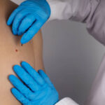 Does Mole Removal Require Multiple Sessions Sometimes