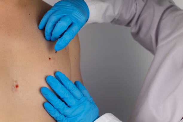 Does Mole Removal Require Multiple Sessions Sometimes
