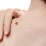 Does Mole Removal Require Special Skincare Products Afterwards