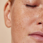 Does Pigmentation Treatment Provide Permanent Results