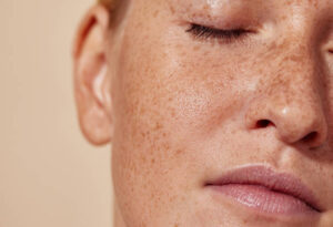 Does Pigmentation Treatment Provide Permanent Results