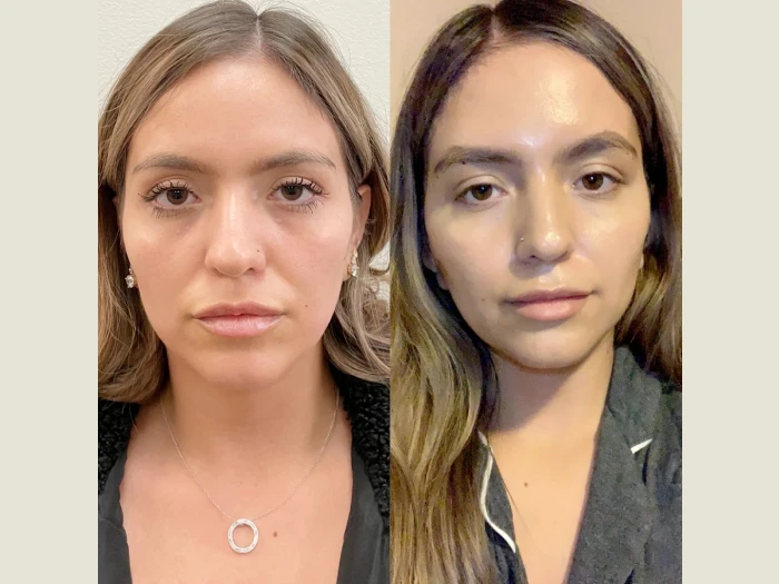 Thread lift Treatments in Dubai for Radiant Youthful Appearance Transformation