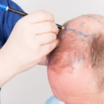 Hair-Transplant-in-Dubai