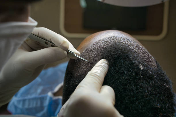 How Can FUE Hair Transplant Boost Your Confidence