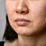 How Laser Acne Scar Treatment Improves Skin Fast