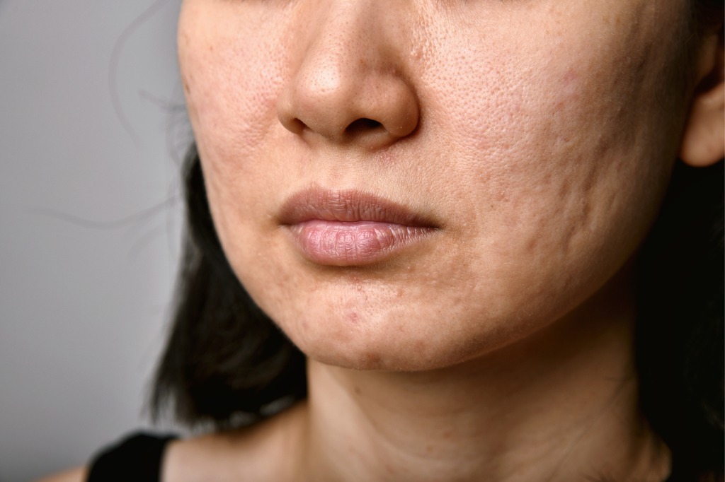 How Laser Acne Scar Treatment Improves Skin Fast