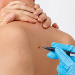 How Long Before Warts Removal Shows Clearer Skin Fast