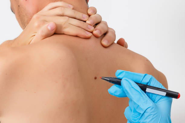 How Long Before Warts Removal Shows Clearer Skin Fast