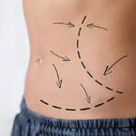 How Long Do Body Jet Liposuction Results Last Usually