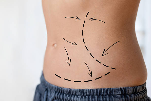 How Long Do Body Jet Liposuction Results Last Usually