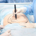 How Often Is Liposuction Performed Successfully