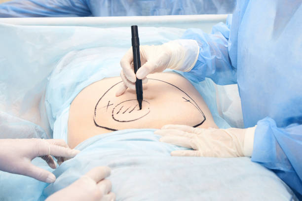 How Often Is Liposuction Performed Successfully