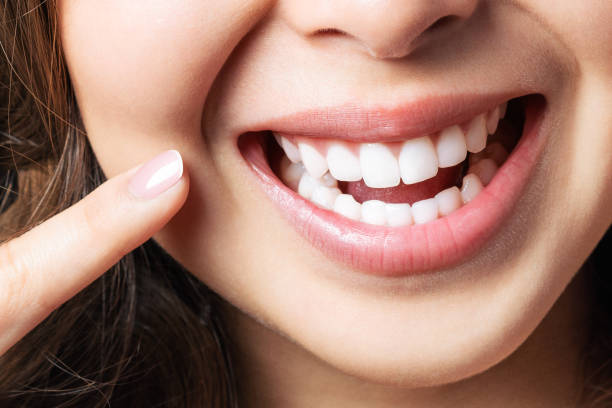 How Often Should You Get Teeth Whitening Sessions