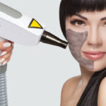 How many sessions of Laser Carbon Peel needed