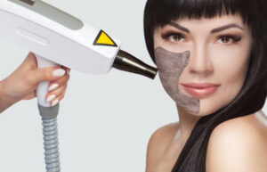 How many sessions of Laser Carbon Peel needed