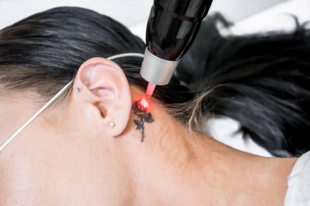 How to Prepare Your Skin Before Tattoo Removal Treatment