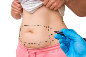 How to Prepare for Liposuction Procedure