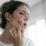Is Acne Treatment Effective for Acne Scar Reduction