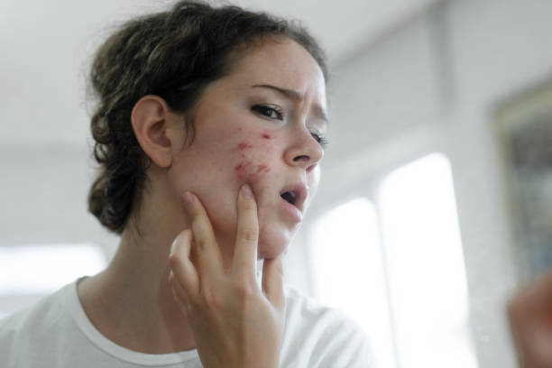 Is Acne Treatment Effective for Acne Scar Reduction