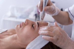 Is Fractional RF Micro Needling Safe for All Skin Tones