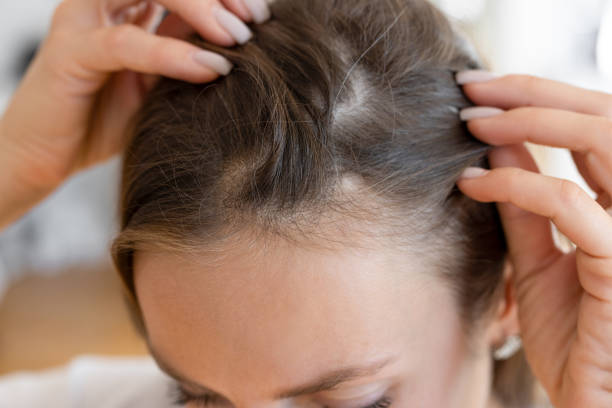 Is Hair Loss Treatment Good for Women With Hair Loss