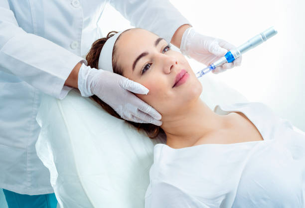 Is Microneedling Good for Stretch Marks Removal