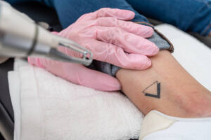 Is Picosure Tattoo Removal Worth It for Clear Skin
