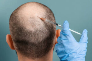 Is Stem Cell Hair Transplant Safe for Early Hair Loss Treatment