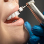 Is Teeth Cleaning really necessary for oral health tips