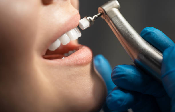 Is Teeth Cleaning really necessary for oral health tips