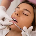 Natural Lip Injections