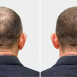 Hair Transplant