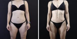Vaser-Lipo-before-and-after