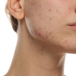 What Questions to Ask Before Laser Acne Scar Treatment