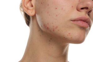 What Questions to Ask Before Laser Acne Scar Treatment
