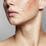 Which Acne Treatment Works for Hormonal Acne