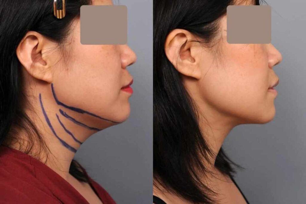 double chin liposuction
