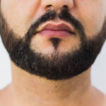 Natural, Permanent Beard Restoration Beard Hair Transplant in Islamabad