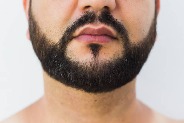 Natural, Permanent Beard Restoration Beard Hair Transplant in Islamabad
