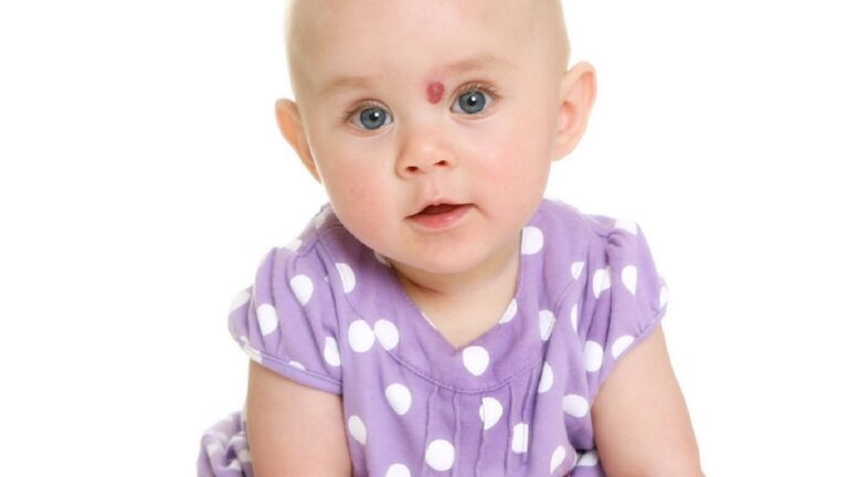 علاج الورم الوعائي الدموي في أبوظبي